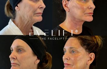female patient before and after EVELIFT®