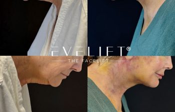 female patient before and after EVELIFT®