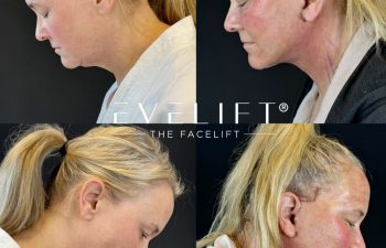 female patient before and after EVELIFT®