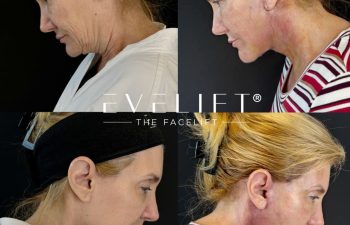 female patient before and after EVELIFT®