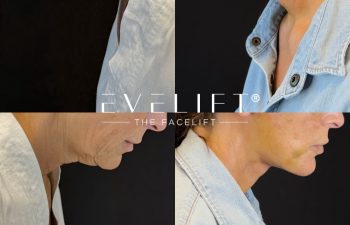 female patient before and after EVELIFT®