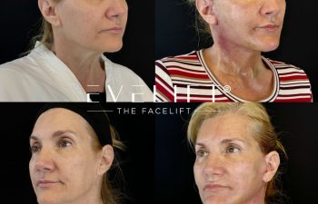female patient before and after EVELIFT®