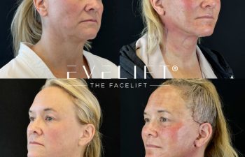 female patient before and after EVELIFT®