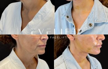 female patient before and after EVELIFT®