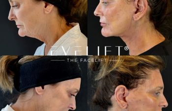 female patient before and after EVELIFT®