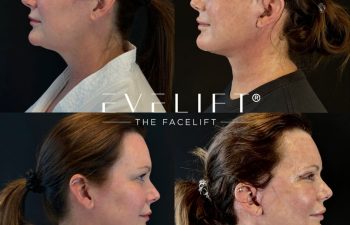 female patient before and after EVELIFT®