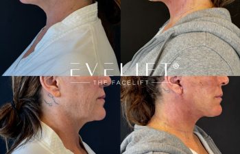 female patient before and after EVELIFT®