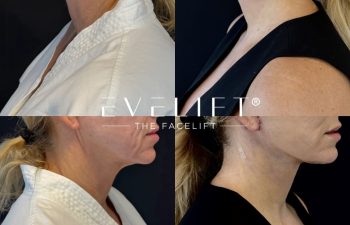 female patient before and after EVELIFT®
