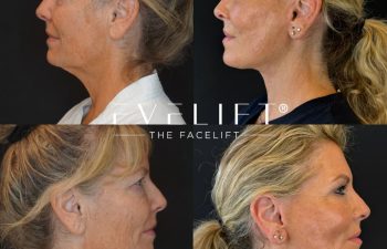 female patient before and after EVELIFT®