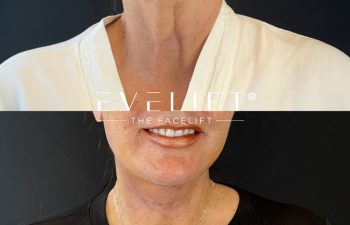 female patient before and after EVELIFT®