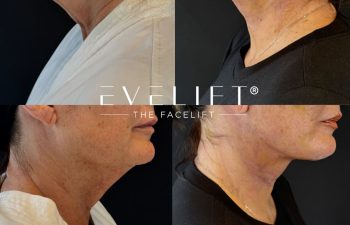 female patient before and after EVELIFT®