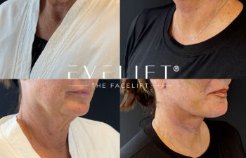 female patient before and after EVELIFT®
