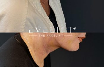 female patient before and after EVELIFT®