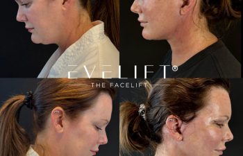 female patient before and after EVELIFT®