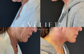 female patient before and after EVELIFT®