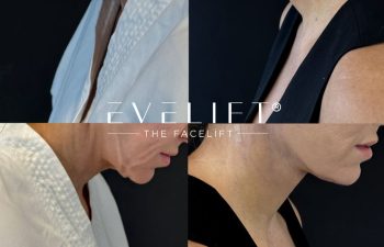 female patient before and after EVELIFT®