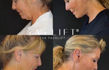 female patient before and after EVELIFT®