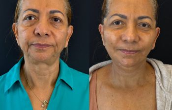 female patient before and after EVELIFT®