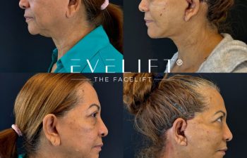 female patient before and after EVELIFT®