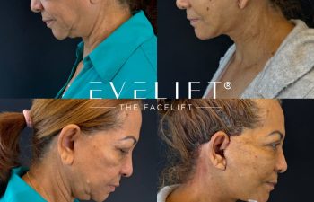 female patient before and after EVELIFT®