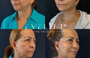 female patient before and after EVELIFT®