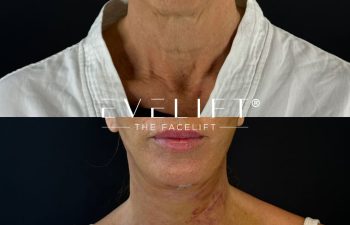 female patient before and after EVELIFT®