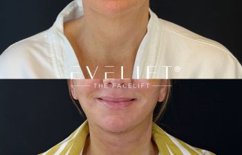 female patient before and after EVELIFT®