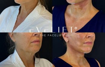 female patient before and after EVELIFT®