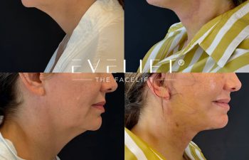 female patient before and after EVELIFT®