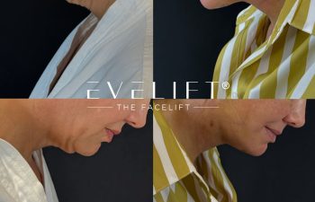 female patient before and after EVELIFT®