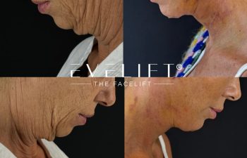 female patient before and after EVELIFT®