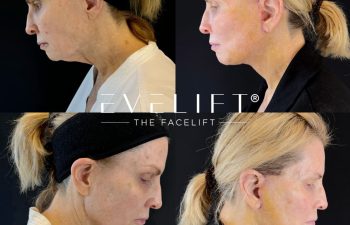 female patient before and after EVELIFT®