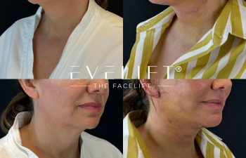female patient before and after EVELIFT®