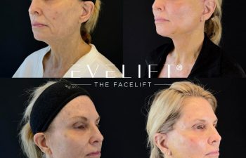 female patient before and after EVELIFT®