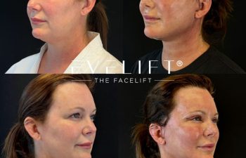 female patient before and after EVELIFT®