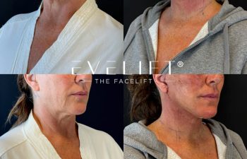 female patient before and after EVELIFT®