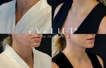 female patient before and after EVELIFT®