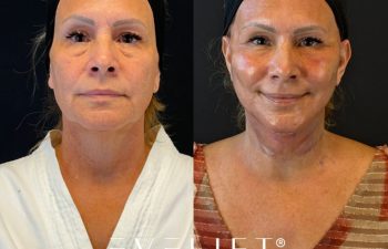 female patient before and after EVELIFT®