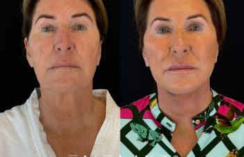 female patient before and after EVELIFT®