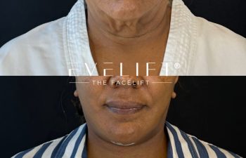 female patient before and after EVELIFT®