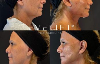 female patient before and after EVELIFT®