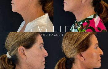 female patient before and after EVELIFT®