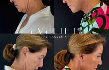 female patient before and after EVELIFT®