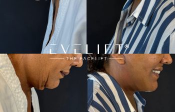 female patient before and after EVELIFT®