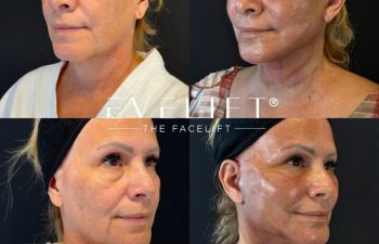 female patient before and after EVELIFT®