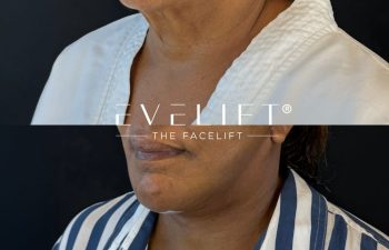 female patient before and after EVELIFT®