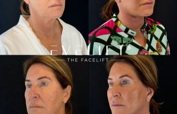 female patient before and after EVELIFT®