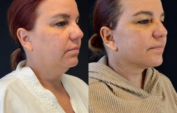 female patient before and after EVELIFT®