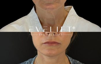 female patient before and after EVELIFT®
