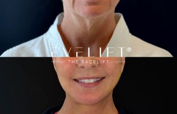 female patient before and after EVELIFT®